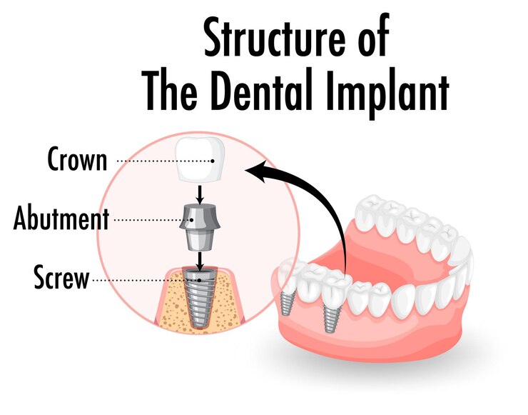 8 key signs you need dental implants (2)